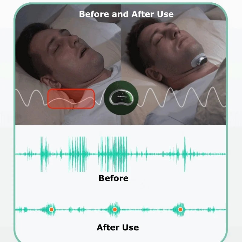 Anti Snoring Smart Device for Adult Sleep Aid to Stop Snoring Analyze Sleep and Snoring Data Wirelessly